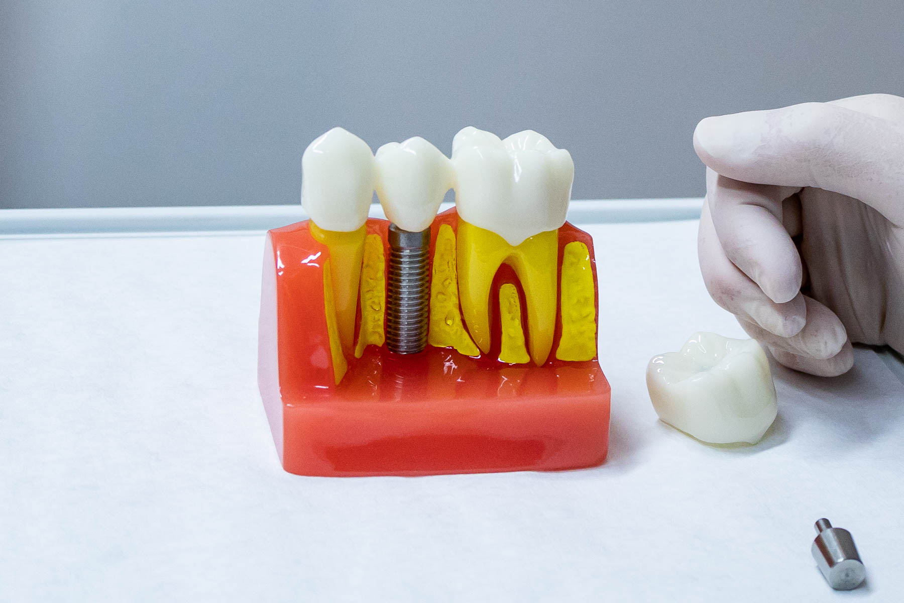Implantatmodell, das die künstliche Wurzel zeigt
